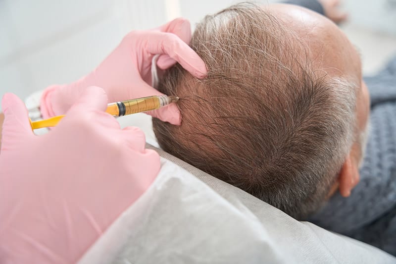 PRP Microneedling - Doctor makes injections in the scalp to the patient